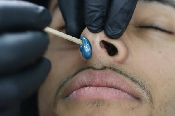 Лазерная эпиляция носа для мужчин